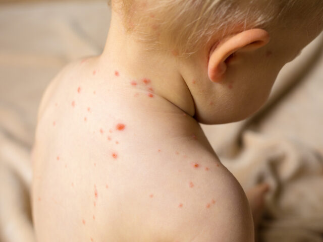 Everything You Need to Know About Measles